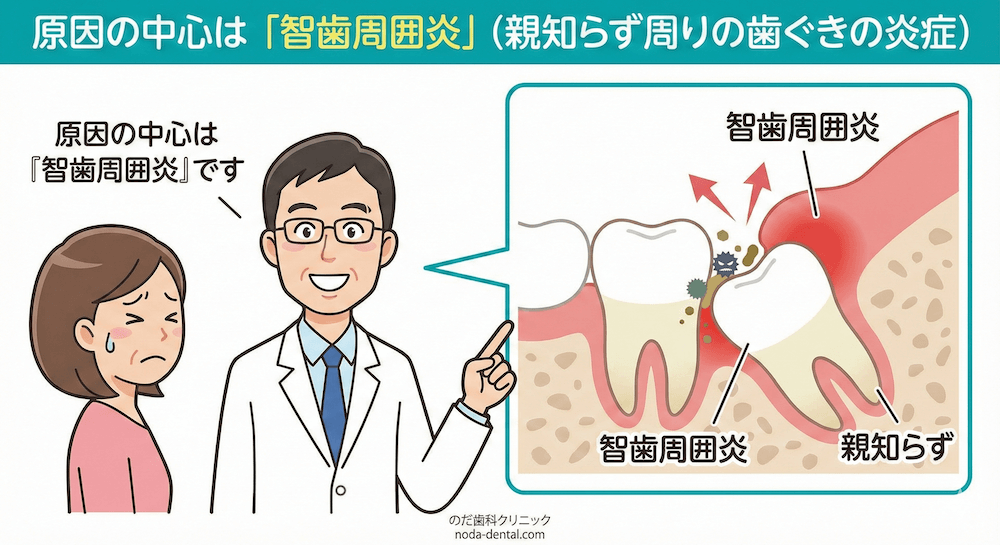 原因の中心は「智歯周囲炎」（親知らず周りの歯ぐきの炎症）