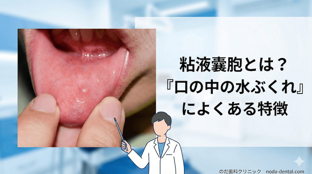 粘液嚢胞とは？「口の中の水ぶくれ」によくある特徴