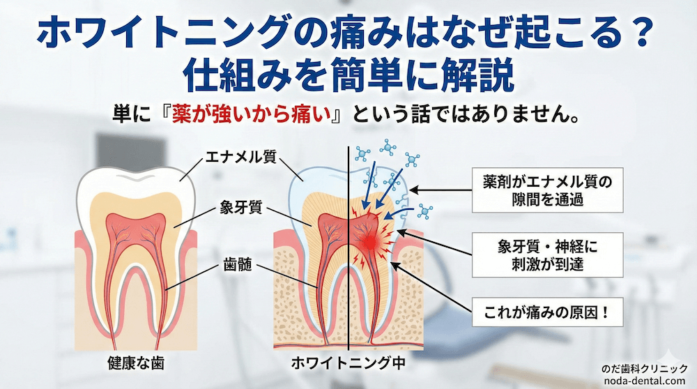 ホワイトニングの痛みはなぜ起こる？仕組みを簡単に解説 
