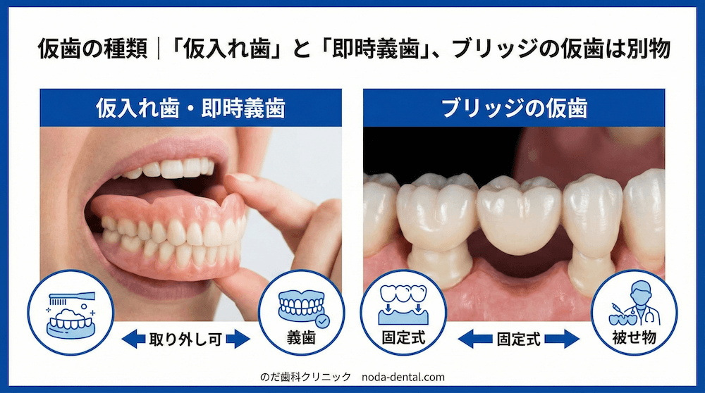 仮歯の種類｜「仮入れ歯」と「即時義歯」、ブリッジの仮歯は別物