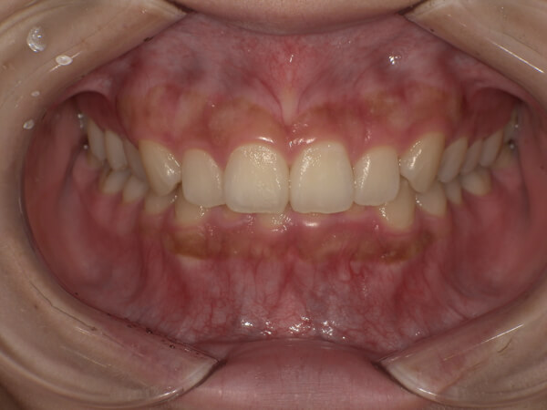 セラミック治療　症例紹介before1