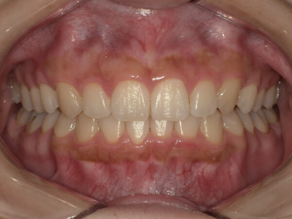 セラミック治療　症例紹介before1