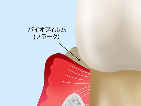 妊娠性歯周炎について