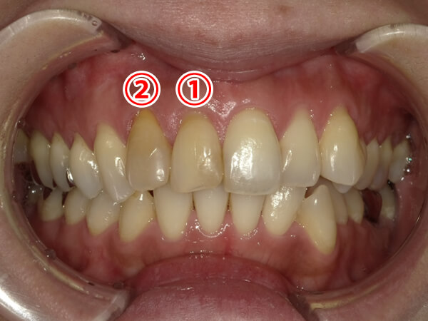 セラミック治療　症例紹介before1