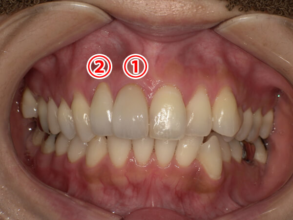 セラミック治療　症例紹介after