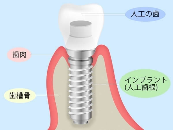 インプラントとは