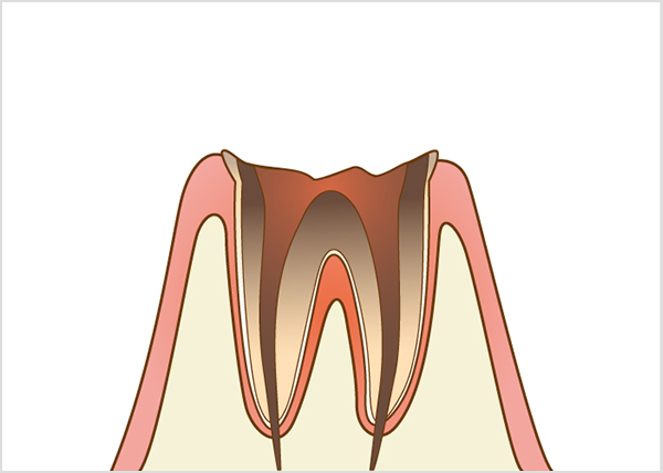 根管治療