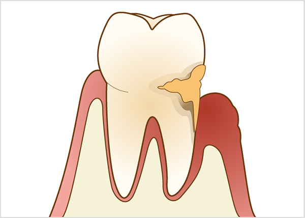 歯周病治療