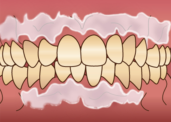 歯肉の着色